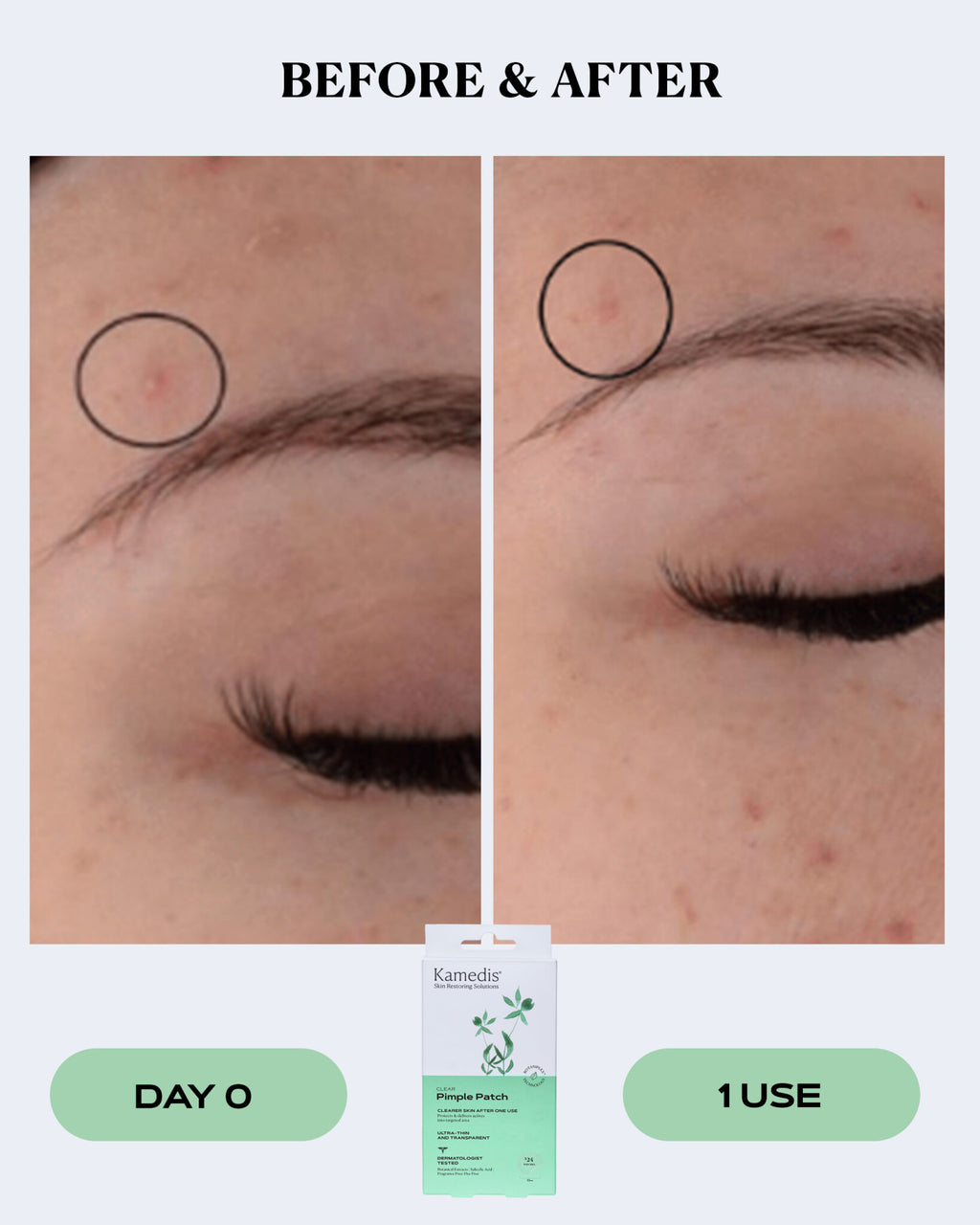 Transparent Pimple Patches for Fast Blemish Relief | CLEAR