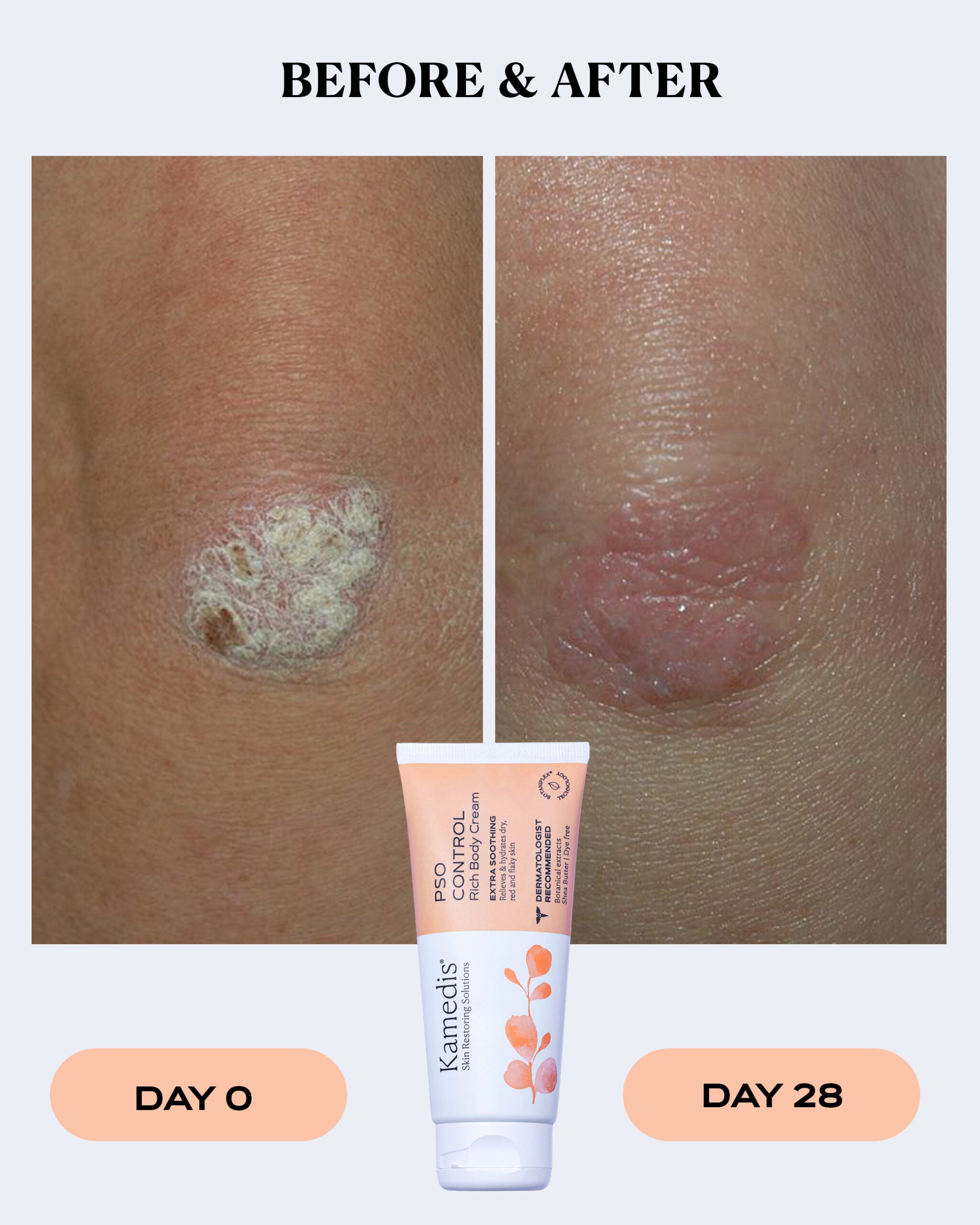 Rich Body Cream for Dry and Scaly Skin | PSO CONTROL