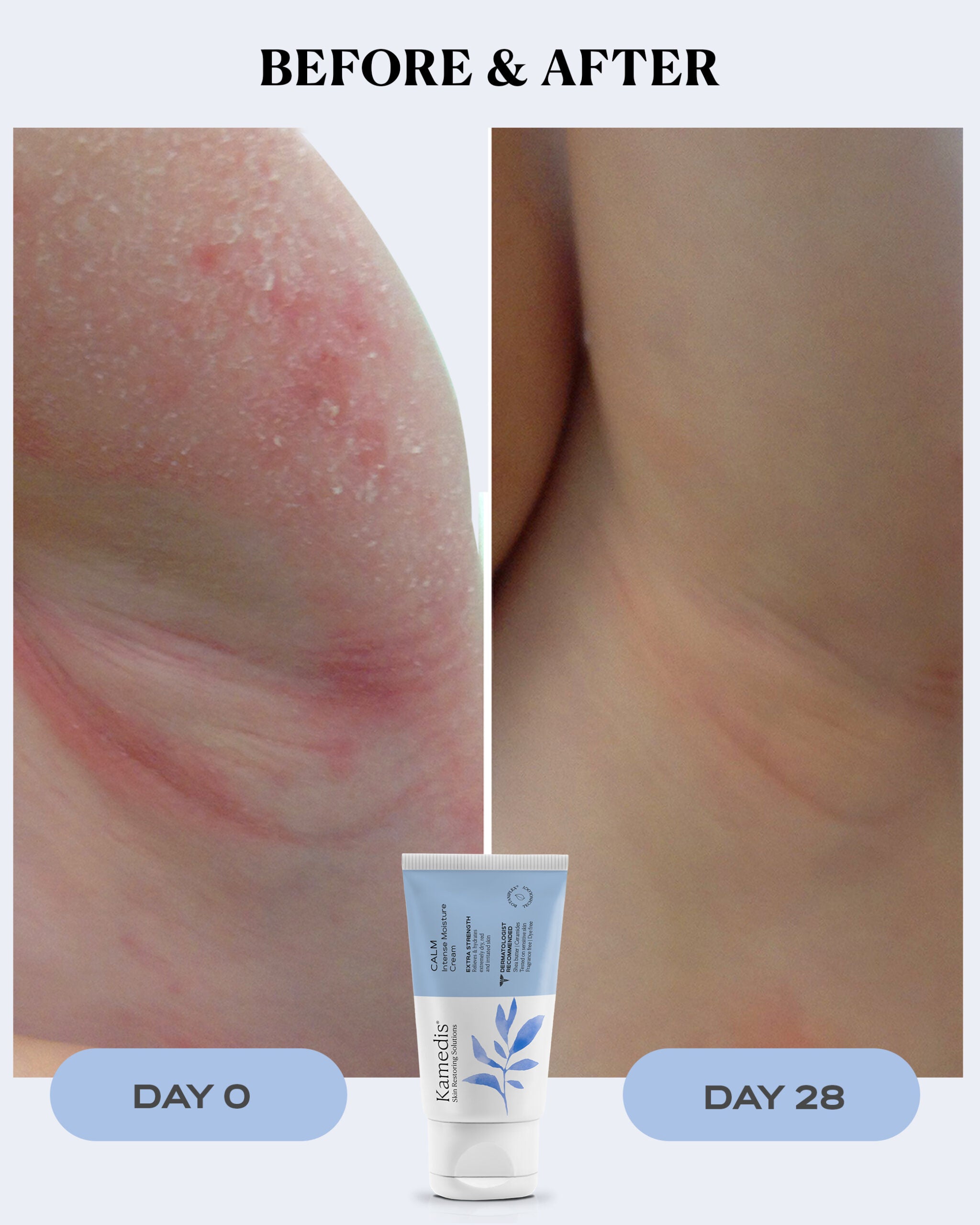 Eczema Therapy Cream