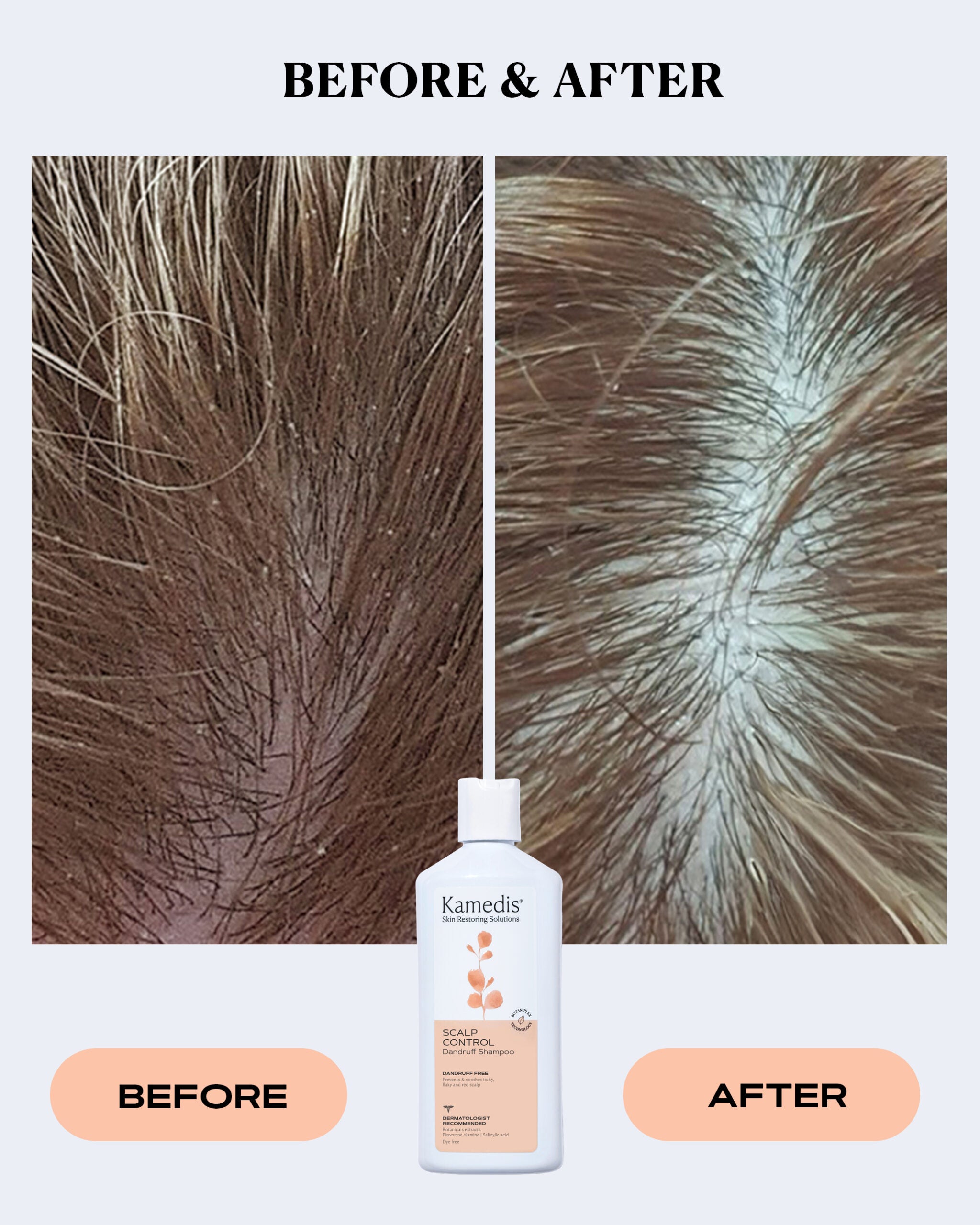 OTC Anti-Dandruff Shampoo 200 ML