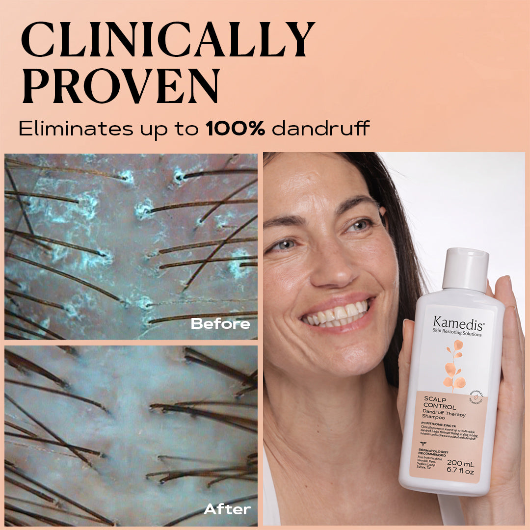 OTC Anti-Dandruff Shampoo 200 ML